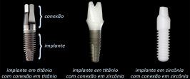 Implantes dentários em zircônia: uma alternativa para o presente ou para o futuro? (Parte I)
